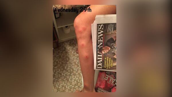 Sabrina Jales St. Pierre claims she suffered from severe bedbugs and is suing a Hilton hotel in California.