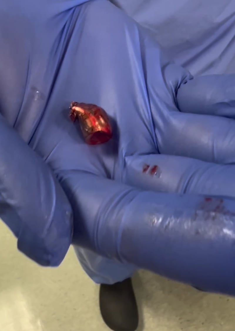 Bakari Sellers, an attorney for the family of a 5-year-old girl who was shot by a Douglas County sheriff's deputy, shared a video of the projectile removed from the girl's arm. This is a screenshot from the 5-second video clip.